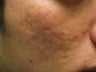 Artefill treatment of Acne Scars