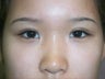 Asian Eye Lid Surgery