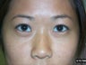 Asian Eye Lid Surgery