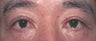 Eyelid Surgery