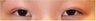 Asian Double Eyelid Surgery - Asian Blepharoplasty