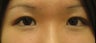 Double eyelid surgery by CO2 laser