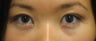 Double eyelid surgery with CO2 laser