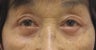 Upper and lower blepharoplasty by laser