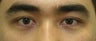 Asian blepharoplasty