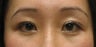 Upper and lower blepharoplasty by CO2 laser