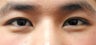 Asian blepharoplasty by incisional technique