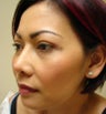 Upper eye lid surgery