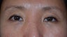 Asian Blepharoplasty to remove eye bags