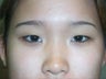 Asian Eye Lid Surgery
