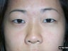 Asian Eye Lid Surgery