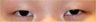Asian Double Eyelid Surgery - Asian Blepharoplasty