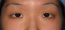 Double eyelid surgery by CO2 laser