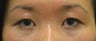 Double eyelid surgery with CO2 laser