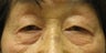 Upper and lower blepharoplasty by laser