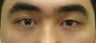 Asian blepharoplasty