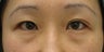 Upper and lower blepharoplasty by CO2 laser