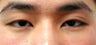 Asian blepharoplasty by incisional technique