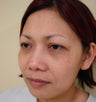 Upper eye lid surgery