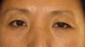 Asian Blepharoplasty to remove eye bags