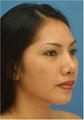 Rhinoplasty