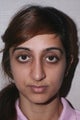 Asian Rhinoplasty