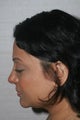Asian Rhinplasty