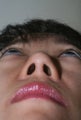 Asian Rhinoplasty