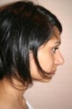 Asian Rhinoplasty