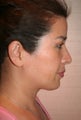 Asian Rhinoplasty