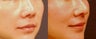 Asian rhinoplasty