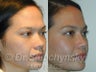 Asian Rhinoplasty