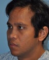 Rhinoplasty-Asian