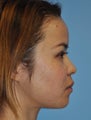Rhinoplasty-Asian