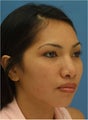 Rhinoplasty