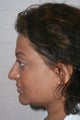 Asian Rhinplasty