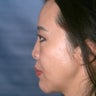 Asian Rhinoplasty