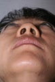 Asian Rhinoplasty