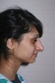 Asian Rhinoplasty