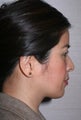 Asian Rhinoplasty
