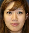 Rhinoplasty