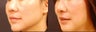 Asian rhinoplasty