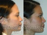 Asian Rhinoplasty