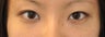 Double Eyelid Surgery - Full Incision