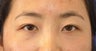 Unilateral (one-sided) Double Eyelid Surgery