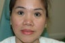 Asian eyelid surgery -- Double lid crease procedure