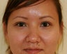 Double Eyelid procedure