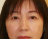 Eyelid rejuvenation