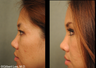 Asian Double Eyelid Surgery