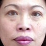 Asian Eyelid Surgery
